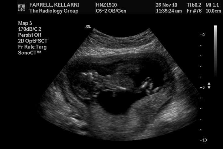 Pregnancy Nuchal Ultrasound 0005