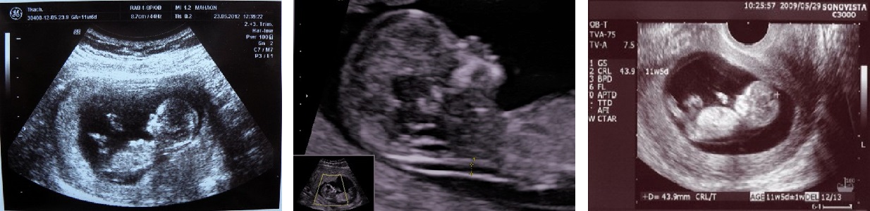 Беременность 11 недель развитие плода фото